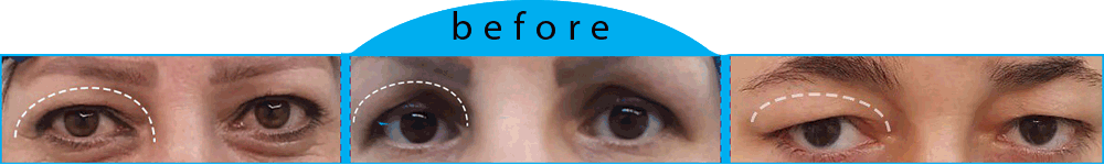 قبل و بعد از جراحی بلفاروپلاستی