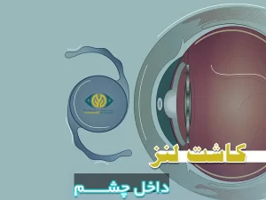 کاشت لنز داخل چشمی