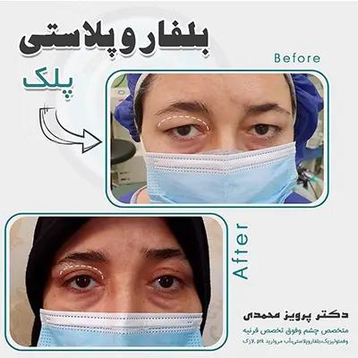 بلفاروپلاستی پلک