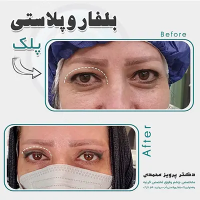 جراحی بلفاروپلاستی