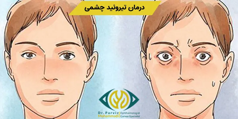 روش های مختلفی برای درمان این بیماری وجود دارد که از جمله این روش ها می توان به درمان دارویی و جراحی اشاره کرد که در ادامه آن ها را بررسی خواهیم کرد. 
