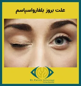این بیماری به طور معمول به صورت تدریجی و به دلیل وجود مشکل در عملکرد عقده های قاعده ای مغز ایجاد خواهد شد. این بخش وظیفه تنظیم حرکات هماهنگ عضلات را بر عهده دارد. علت دقیقی برای بروز این بیماری وجود ندرد و این بیماری به خودی خود و ایجاد شده و ممکن است خشکی چشم عامل محرکی برای شروع این بیماری باشد. در برخی از موارد دیده شده که این بیماری در افراد یک خانواده نیز بروز پیدا کرده که در نتیجه شاید زمینه های ارثی و ژنتیکی نیز در بروز آن موثر باشند.  